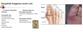 Penyebab Asam Urat dan Cara Mengatasinya