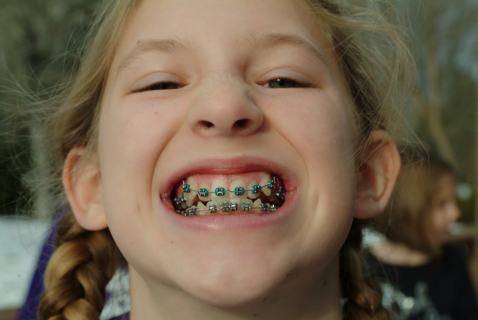 Pass the wine, metal mouth: The whole tooth about wearing