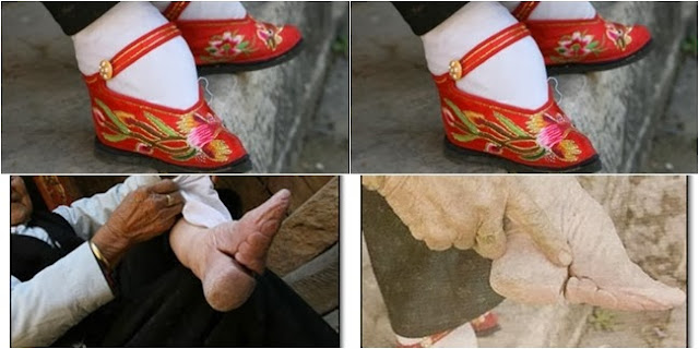 Footbinding