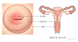 자궁경부, 자궁경부암증상, 자궁경부암 원인, 자궁경부암 백신, 자궁경부암 치료, 자궁경부 영어, 자궁경부암 검사, 자궁 경부 사진, 자궁경부암 남자, 자궁경부암 원인 남자, 자궁경부 염증