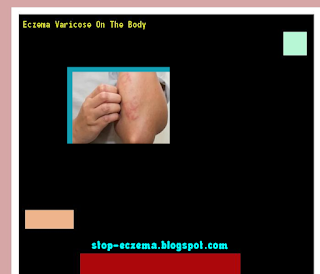 Eczema varicose on the body