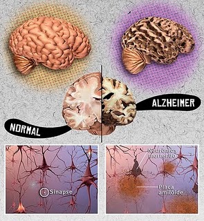 Resultado de imagem para Doença de Alzheimer