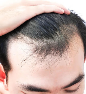 Best Alopecia Hair Loss Treatment Deals in Bangalore