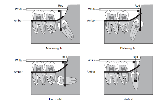 Kedalaman gigi impaksi molar tiga metode Winter's Line