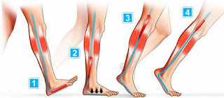 tratamiento varices piernas hinchadas edema venas