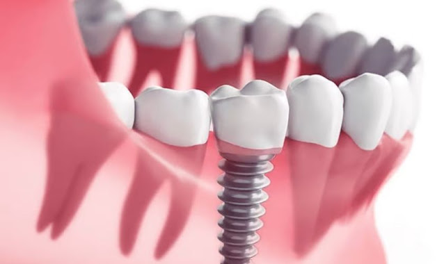 Dental Implants in Puyallup