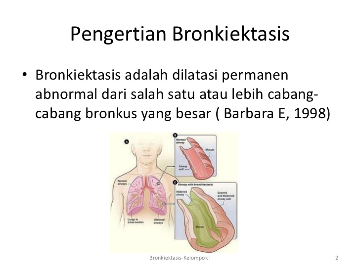 Berbagai Pengertian Bronkiektasis Menurut Para Ahli 