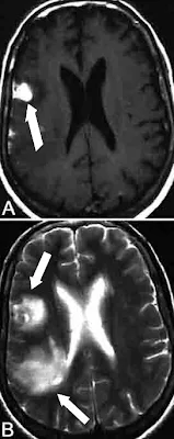 tuberculose do sistema nervoso central