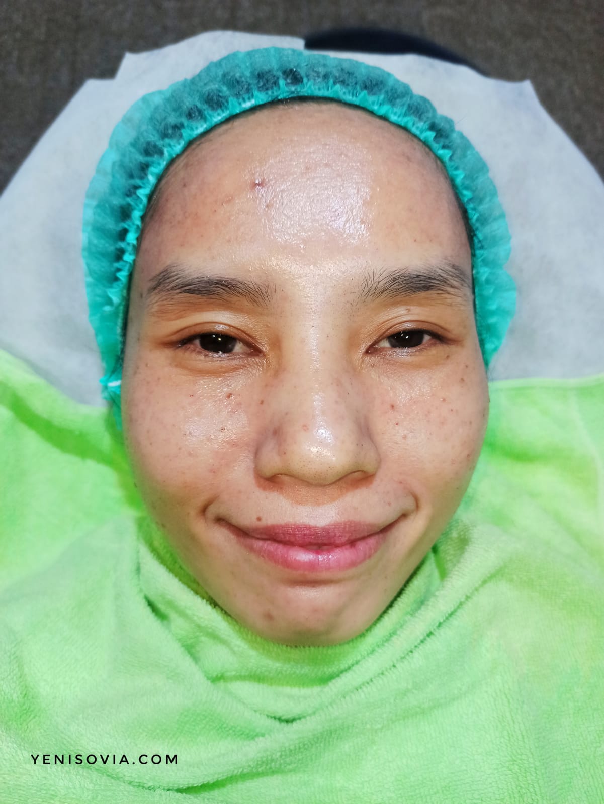 Hasil treatment di ZAP Clinic