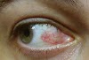 HERPES OCULAR:  Estresse favorece surgimento da doença 