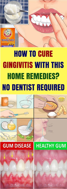 How To Cure Gingivitis & This Home Remedies? No Dentist Required!!!