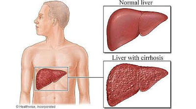 Obat Sirosis Hati