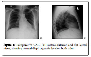 Right Internal Mammary Artery 