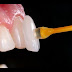 Bọc răng sứ có ưu điểm gì?