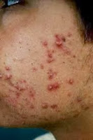 Conseils Acné:  4 conseils pour réduire l'acné