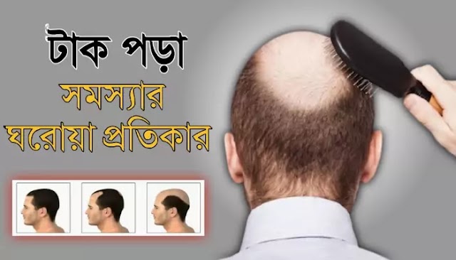 টাক পড়ার সমস্যার ১০টি ঘরোয়া প্রতিকার | 10 Home Remedies for Baldness