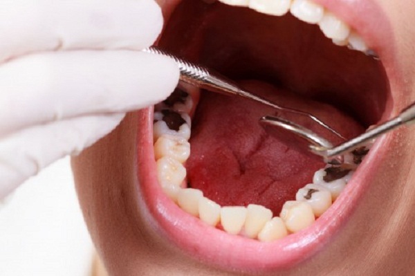 Răng bị sâu đen nặng phải làm sao?