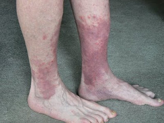 <img alt='bad circulation feet' src='http://i46.tinypic.com/b5goaw.jpg'/>