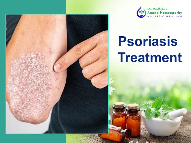 psoriasis treatment