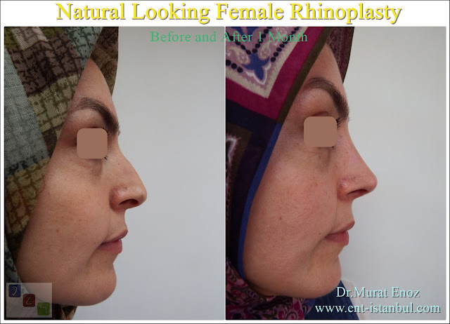 Natural rhinoplasty,Natural Nose Aesthetic Surgery,Natural Nose Job,Natural Looking Nose Operation,