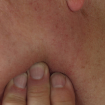 Swollen Lymph Nodes under jaw one side Symptoms, Causes, Treatment