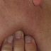 Swollen Lymph Nodes under jaw one side Symptoms, Causes, Treatment