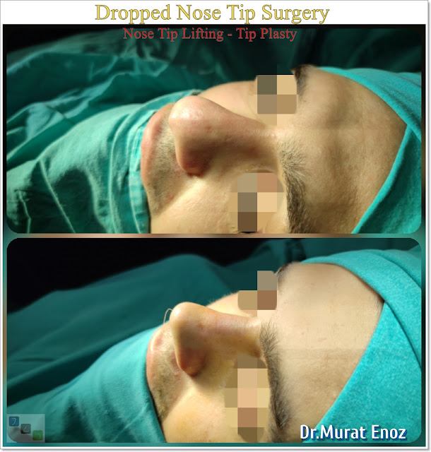 Nose Tip Lifting,Drooping Nose Tip,Nose Tip Surgery in İstanbul,Nose tip plasty,Nasolabial Angle,