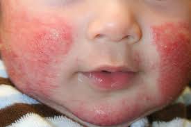 Dipper Rash, Baby Skin Problem, child care