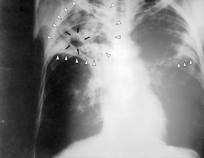 tuberculosis x ray. x-ray - Radiology and Medical