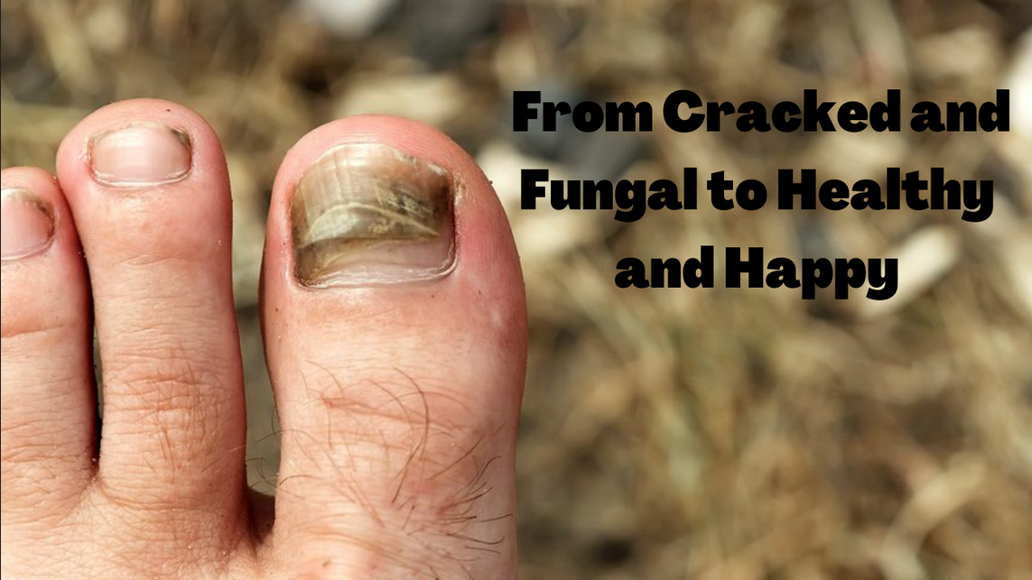 From Cracked and Fungal to Healthy and Happy: Restoring Toenail Health