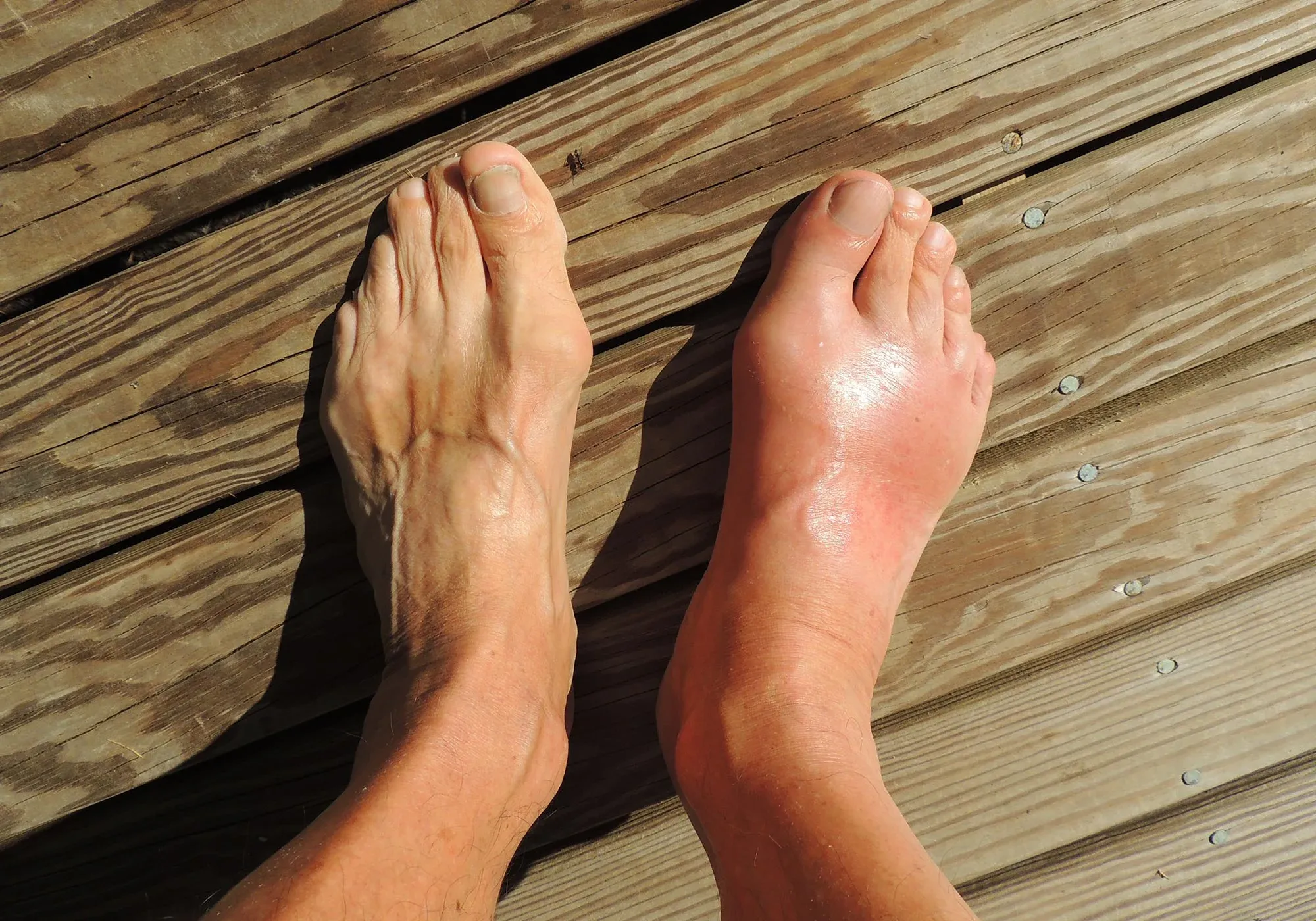 Gout and Genetic Factors