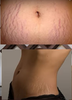 Stretch Marks Happen In The First Place