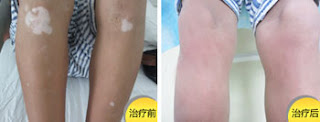 Beijing Meidi vitiligo Hospital - Cause and Cure Vitiligo 