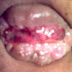 Pengobatan Herbal Wasir Bengkak thumbnail