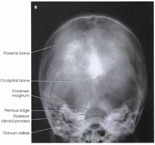 skull xray