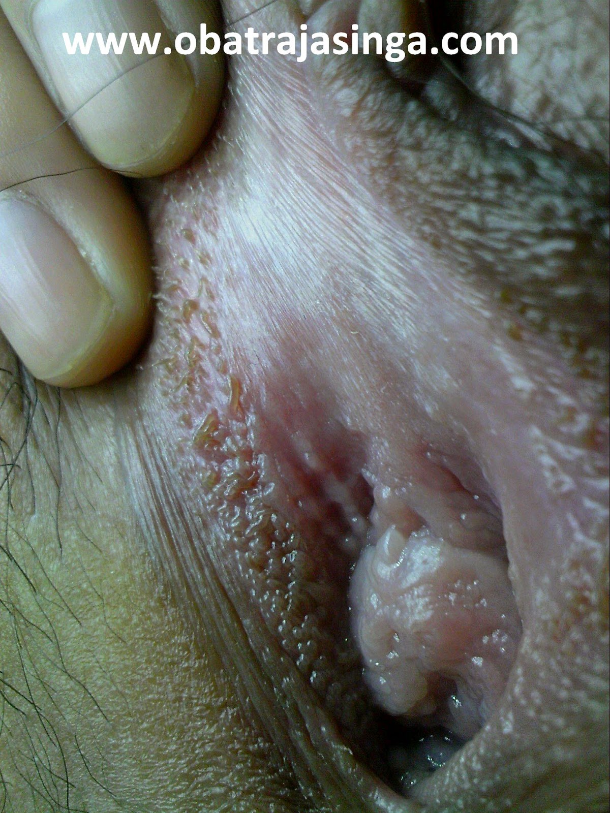 Obat Penyakit Hpv