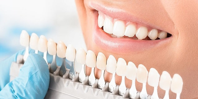 benefits of dental veneers new teeth