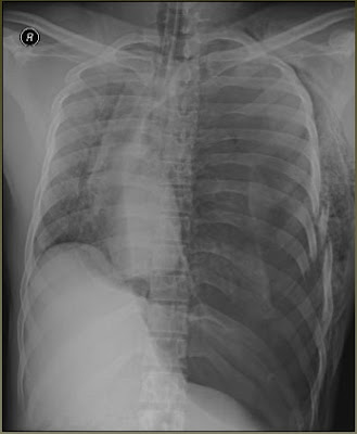 Rib Fractures with Open