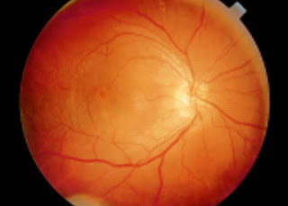 What is Macular Edema?