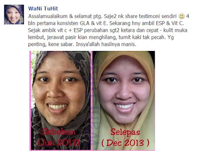 Rawat jerawat dengan Vitamin E Shaklee