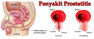 Obat Kanker Herbal Tradisonal Dan Alami 