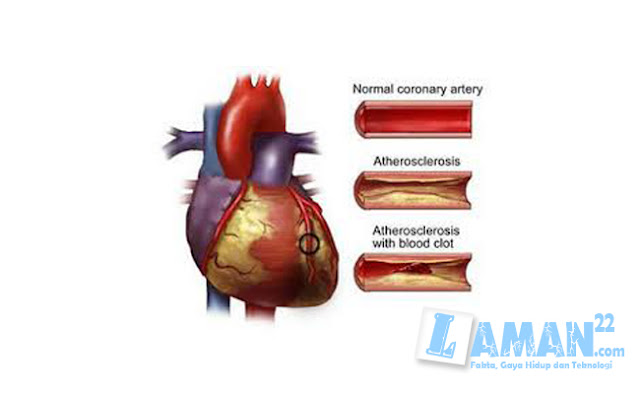 Kenali Penyebab Utama Sakit Jantung Koroner