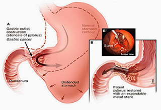 Cara Pengobatan Penyakit Tumor Lambung