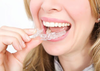 Niềng răng invisalign giá bao nhiêu-2