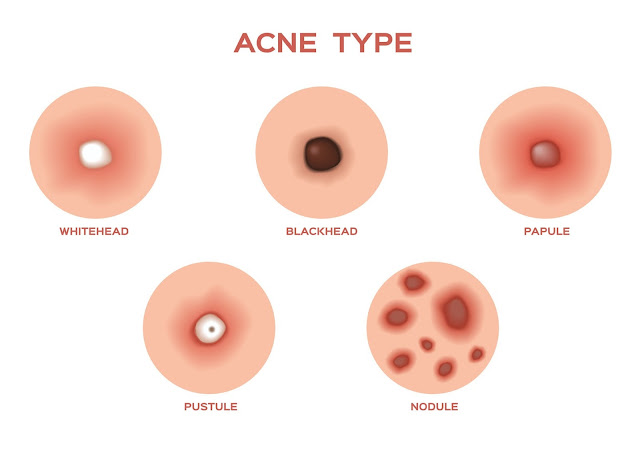 What is Skin Acne Types 01