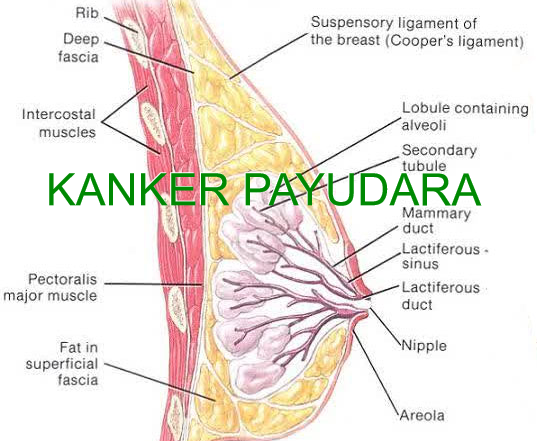 kangker payudara