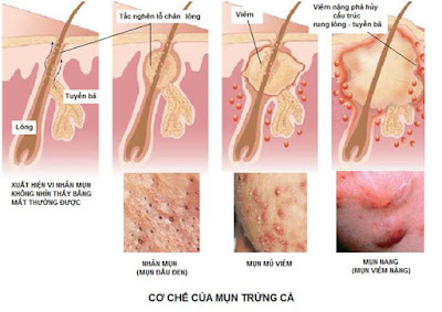 tại sao da lại bị mụn