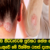 හමේ ලෙඩ නිට්ටාවටම සුවකර ගන්න ගන්සූරිය පස් පංගුවේ මේ විශ්මිත රහස් දැනගන්න.