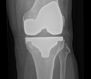 Pros and Cons of Conformis Knee Replacement