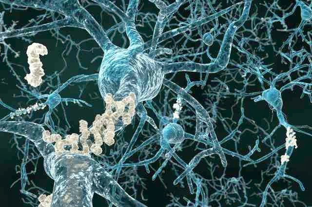 Clumps Of Alzheimer's-Associated Molecule Found In Young Adult Brains
